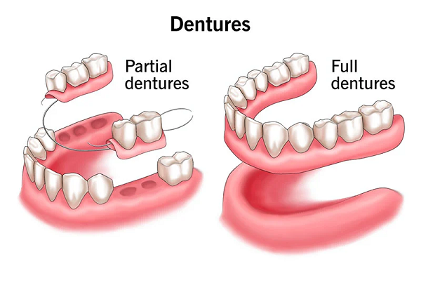 Denture and Partial Dentures